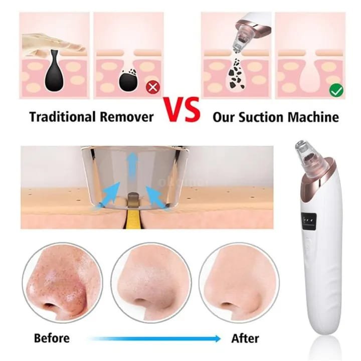 Blackhead Remover